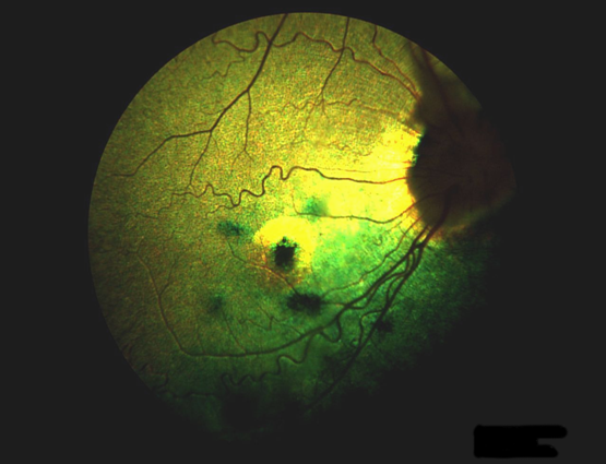 Retinopatia siatkówki.png